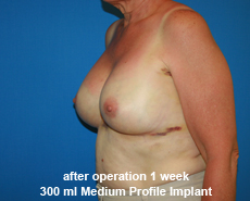 plastic-surgery-breast-augmentation
